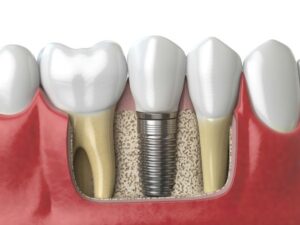 anatomy of healthy teeth and tooth dental implant 2021 08 26 16 56 57 utc c